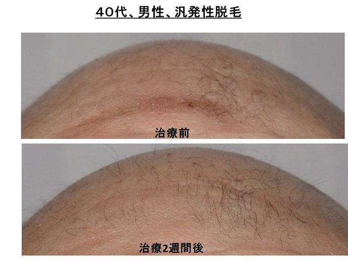 円形脱毛症　病院
